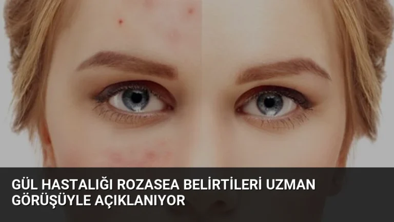 Gül Hastalığı Rozasea Belirtileri Uzman Görüşüyle Açıklanıyor