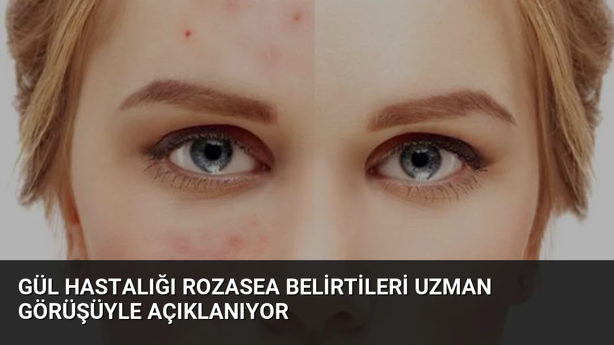 Gül Hastalığı Rozasea Belirtileri Uzman Görüşüyle Açıklanıyor