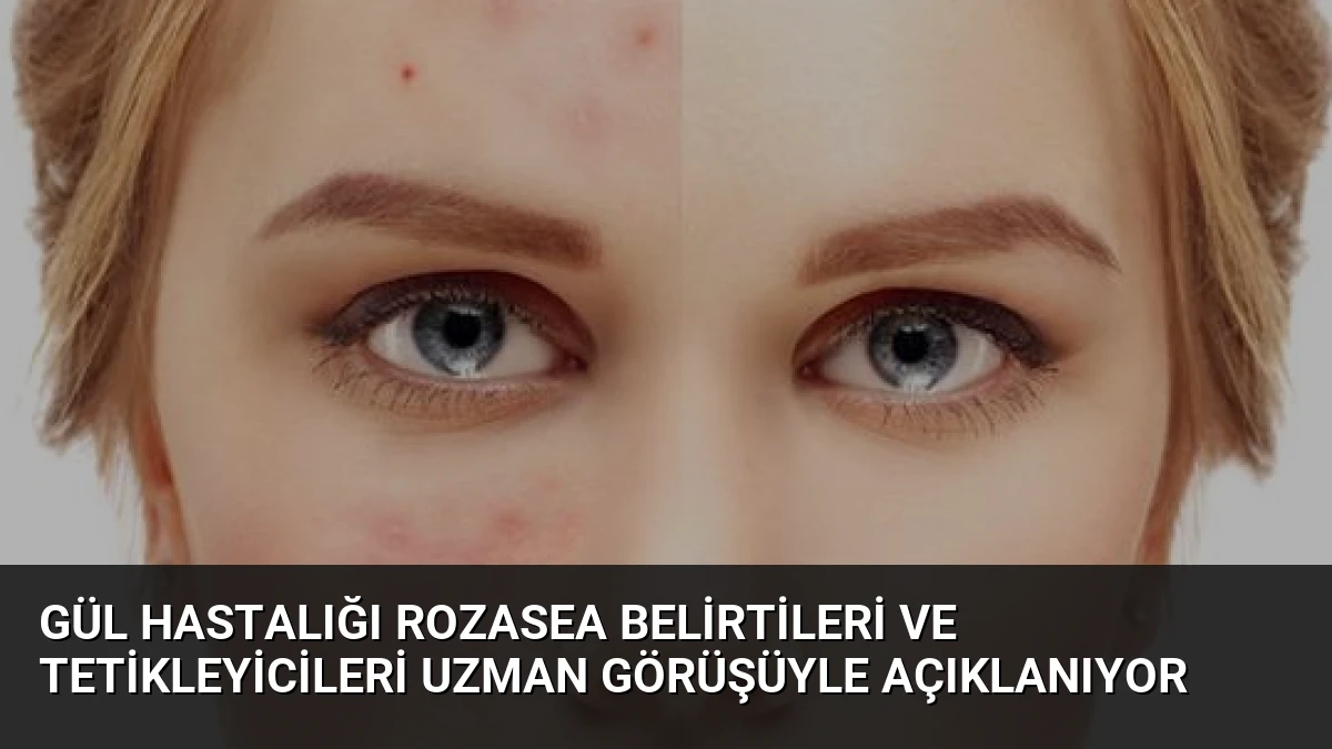 Gül Hastalığı Rozasea Belirtileri ve Tetikleyicileri Uzman Görüşüyle Açıklanıyor