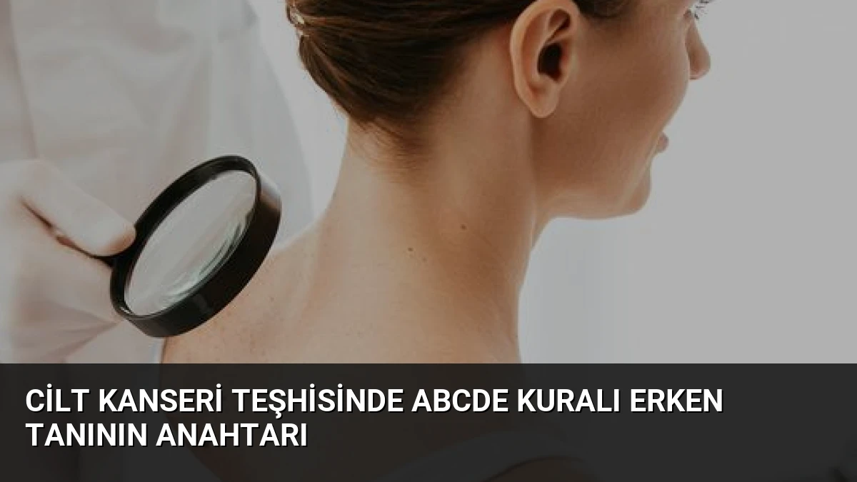 Cilt Kanseri Teşhisinde ABCDE Kuralı Erken Tanının Anahtarı